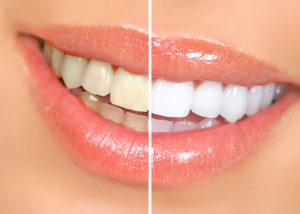 Mouth and teeth before and after whitening