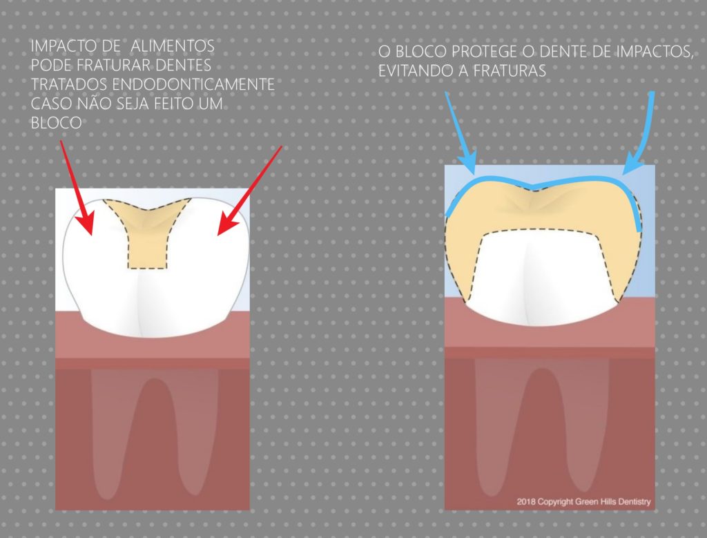 bloco e coroa dentária