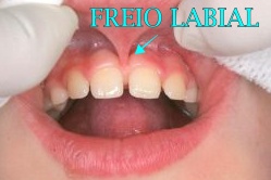 freio labial diastema