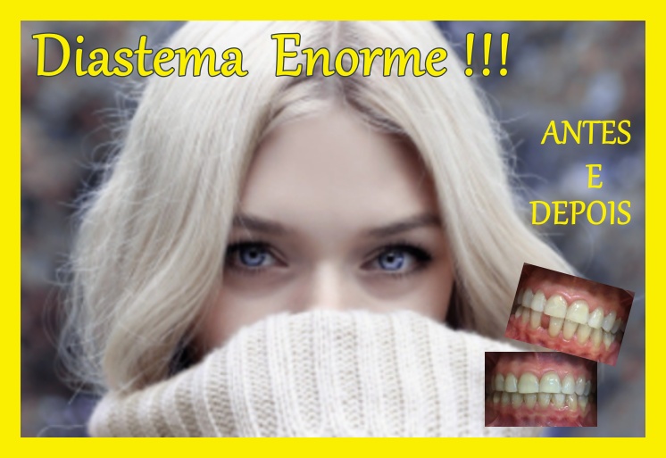 Diastema Enorme !!! Dentes da Frente Muito separados !!! Como Resolver Diastema ??? Tratamento Ortodôntico ?