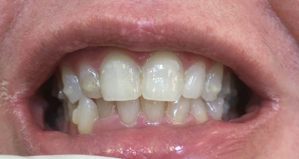 invisalign com attachments