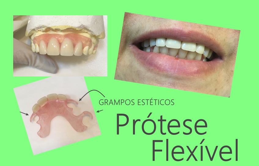 protese dentaria flexivel